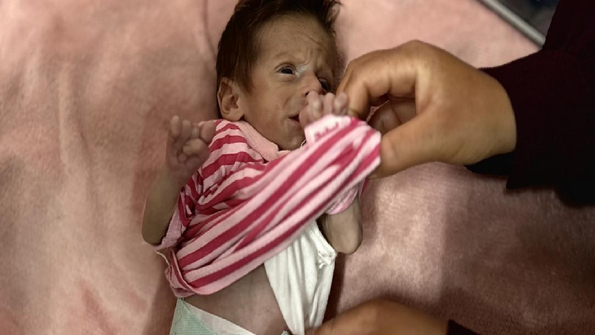 Gazze’de bir bebek daha açlık yüzünden can vermek üzere