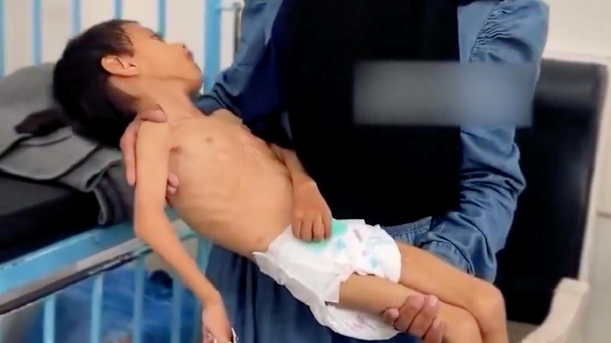 Gazze’de bir çocuk daha yetersiz beslenme nedeniyle ömür savaşı veriyor