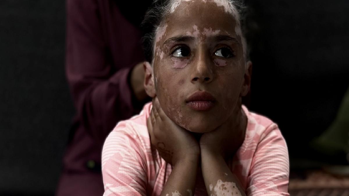 Gazzeli Lana, İsrail korkusu yüzünden vitiligo hastalığına yakalandı