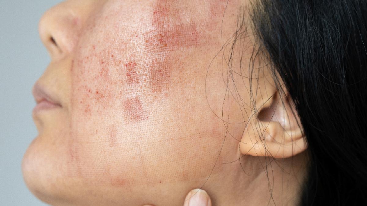 Lupus hastalığı hakkında bilmeniz gerekenler